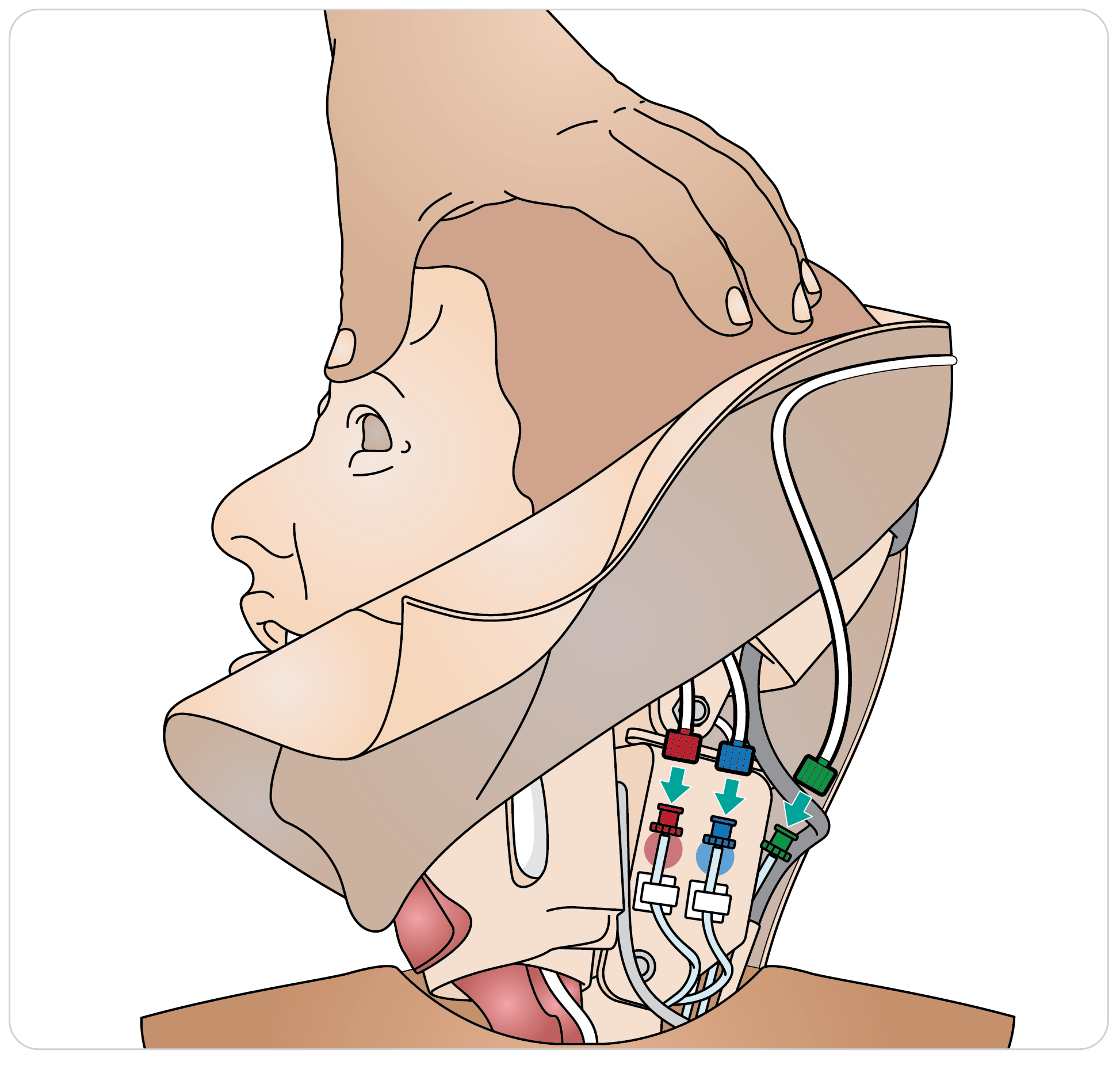 Paligo__Trauma_Head_Neck_Airway_04.png