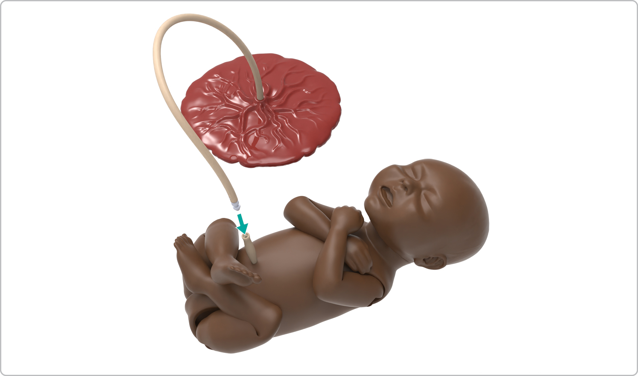 MA_Cephalic_Placenta_on.jpg
