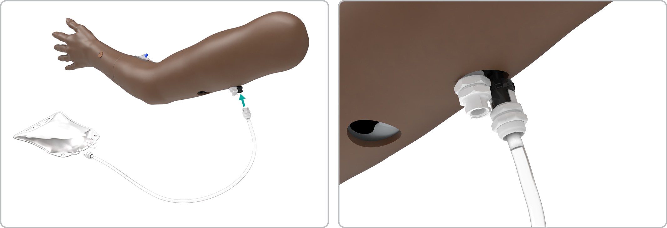MA_Arm_IV_drain_bag_on.jpg